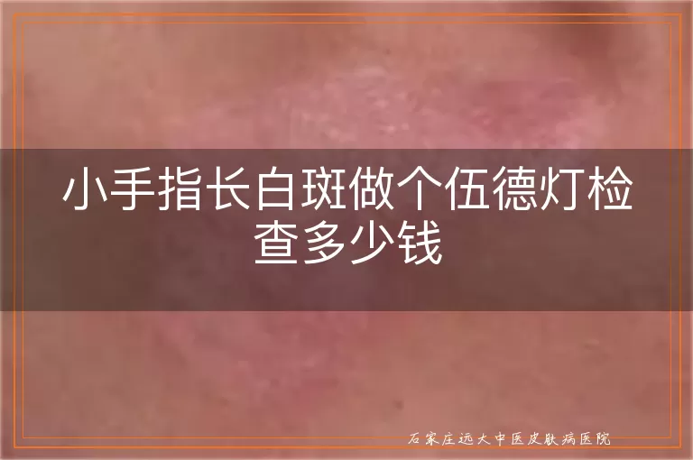 小手指长白斑做个伍德灯检查多少钱