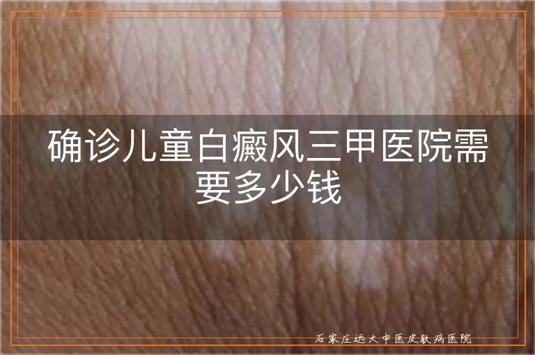 确诊儿童白癜风三甲医院需要多少钱