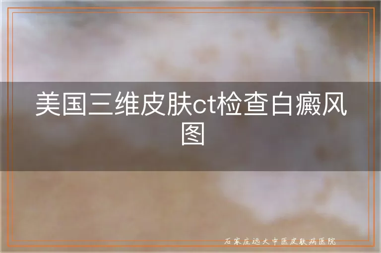 美国三维皮肤ct检查白癜风图
