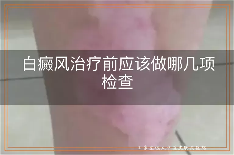 白癜风治疗前应该做哪几项检查