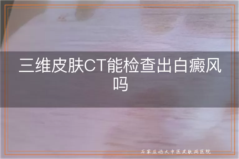 三维皮肤CT能检查出白癜风吗