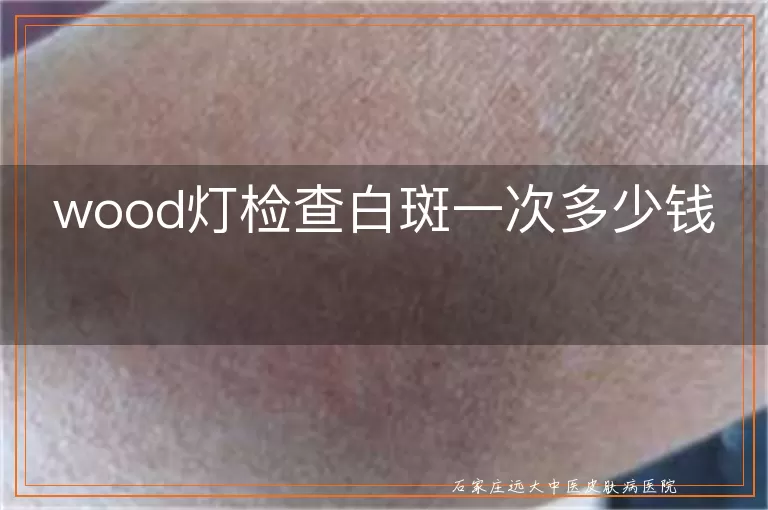 wood灯检查白斑一次多少钱