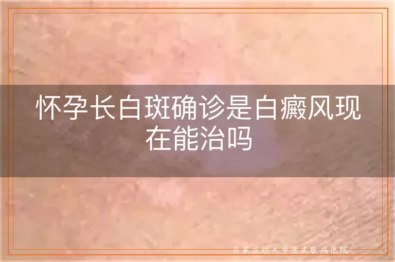 怀孕长白斑确诊是白癜风现在能治吗