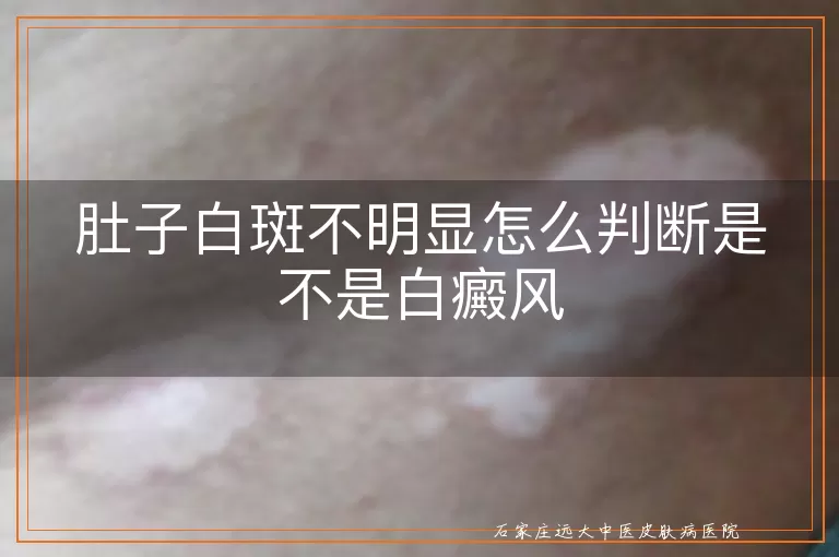 肚子白斑不明显怎么判断是不是白癜风