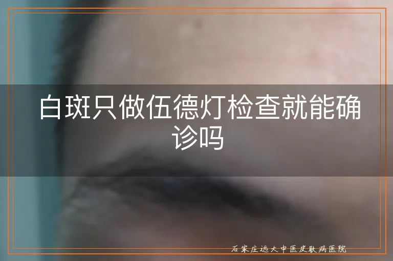 白斑只做伍德灯检查就能确诊吗