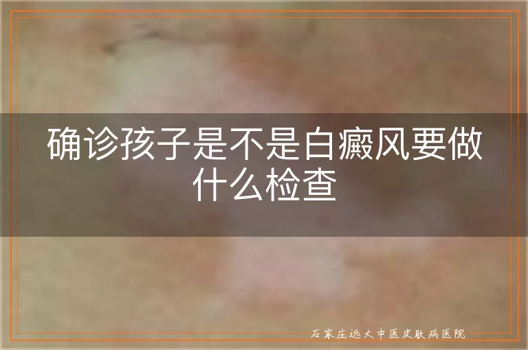 确诊孩子是不是白癜风要做什么检查