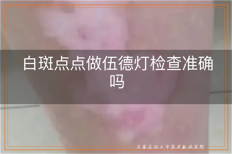 白斑点点做伍德灯检查准确吗