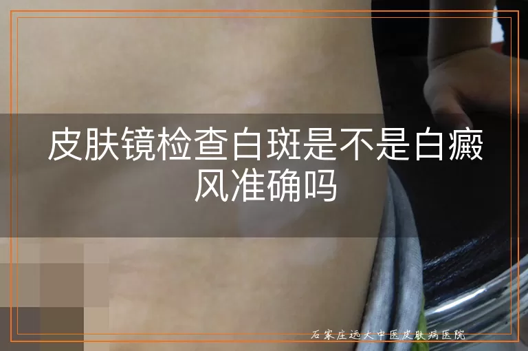 皮肤镜检查白斑是不是白癜风准确吗