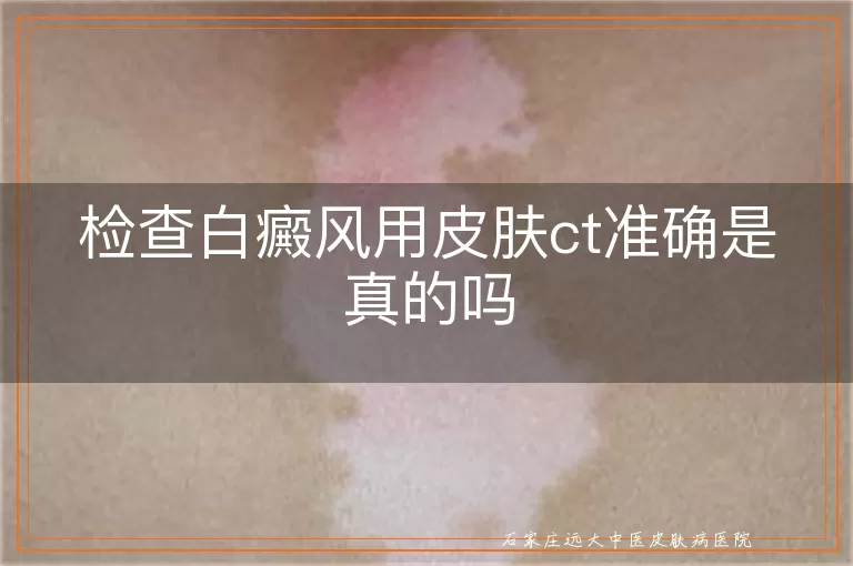 检查白癜风用皮肤ct准确是真的吗
