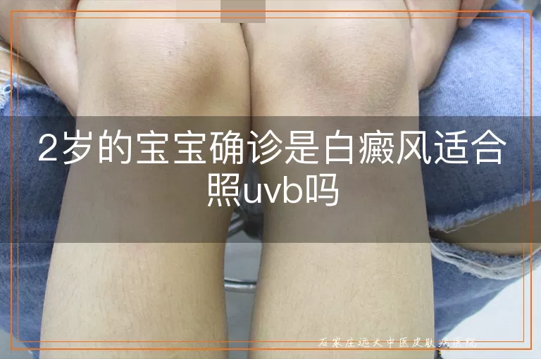 2岁的宝宝确诊是白癜风适合照uvb吗