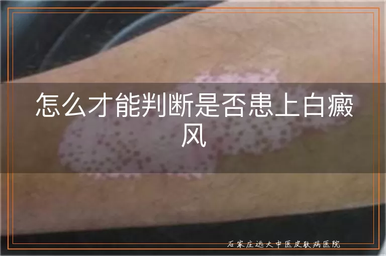 怎么才能判断是否患上白癜风
