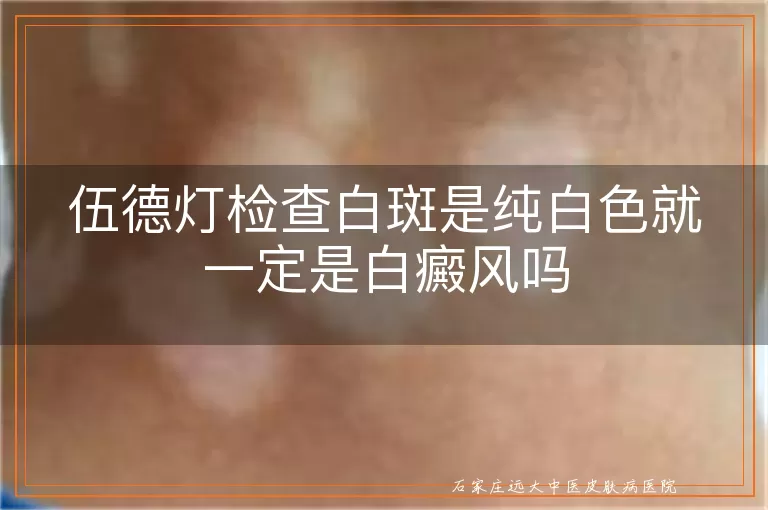 伍德灯检查白斑是纯白色就一定是白癜风吗