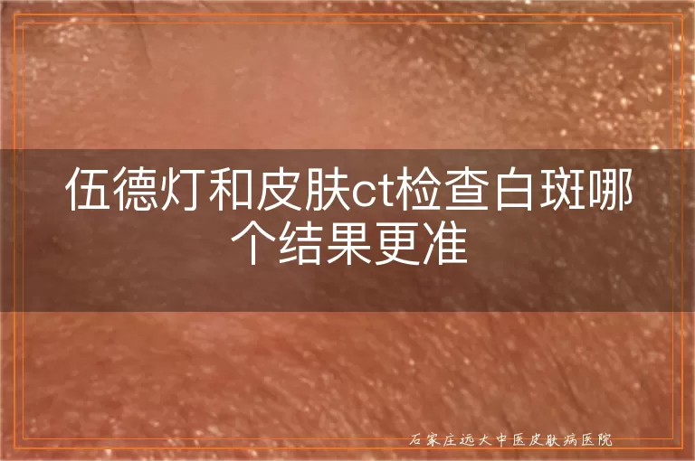 伍德灯和皮肤ct检查白斑哪个结果更准