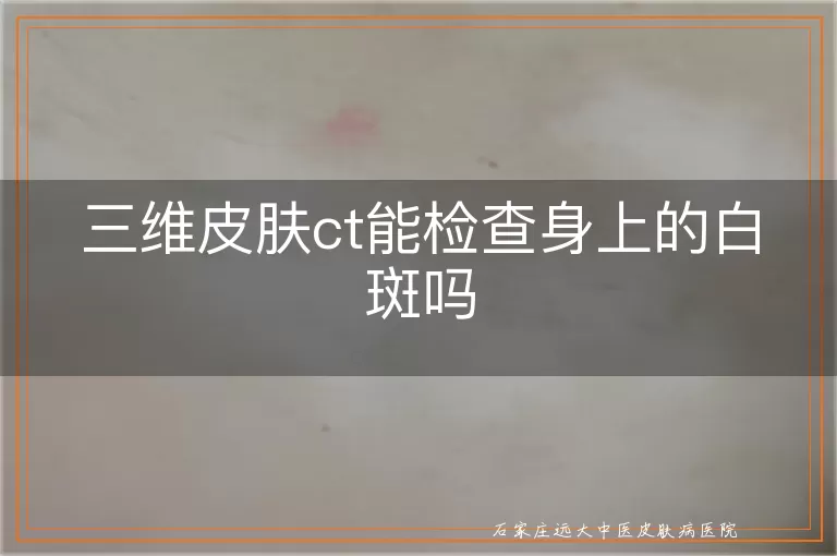 三维皮肤ct能检查身上的白斑吗