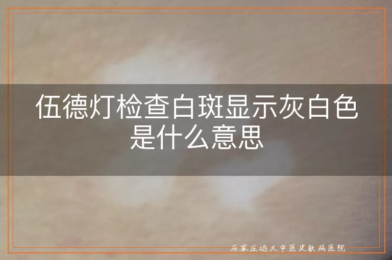 伍德灯检查白斑显示灰白色是什么意思