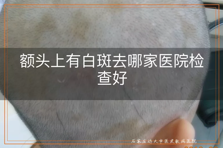 额头上有白斑去哪家医院检查好