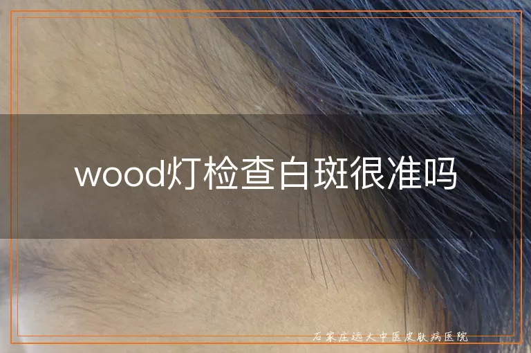 wood灯检查白斑很准吗