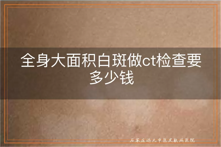 全身大面积白斑做ct检查要多少钱