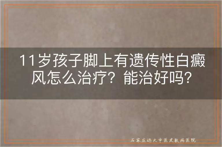 11岁孩子脚上有遗传性白癜风怎么治疗？能治好吗？