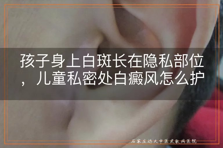 孩子身上白斑长在隐私部位,儿童私密处白癜风怎么护理