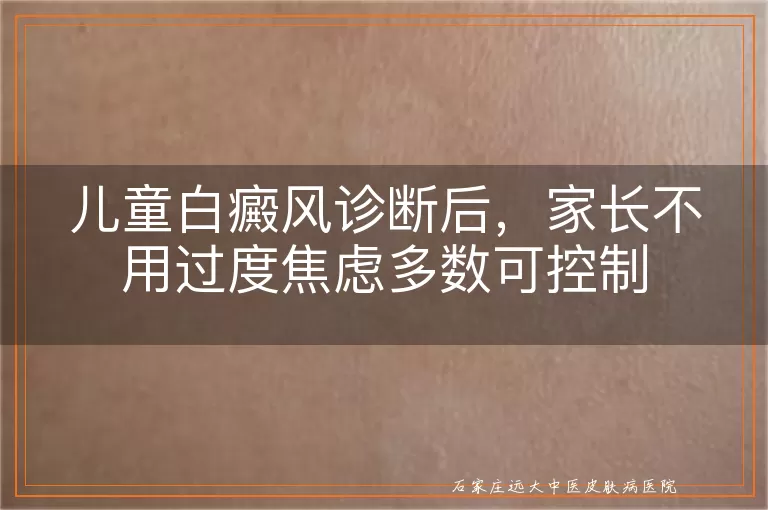 儿童白癜风诊断后,家长不用过度焦虑多数可控制