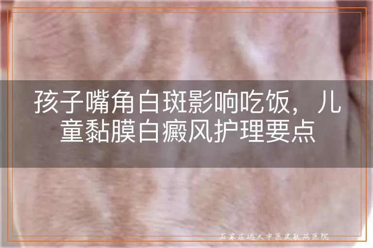 孩子嘴角白斑影响吃饭,儿童黏膜白癜风护理要点
