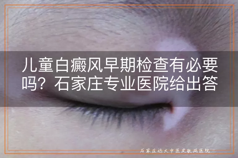 儿童白癜风早期检查有必要吗?石家庄专业医院给出答案