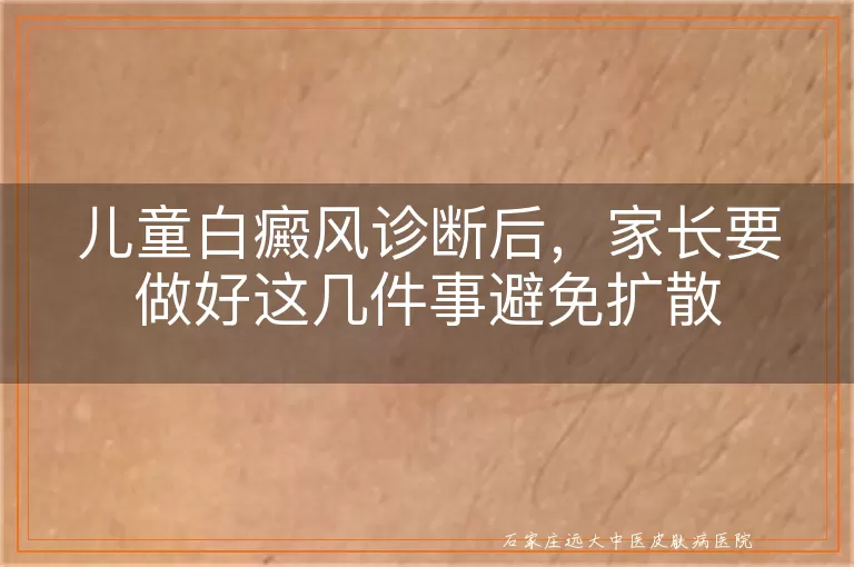 儿童白癜风诊断后,家长要做好这几件事避免扩散