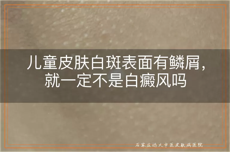 儿童皮肤白斑表面有鳞屑,就一定不是白癜风吗