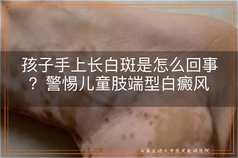 孩子手上长白斑是怎么回事?警惕儿童肢端型白癜风