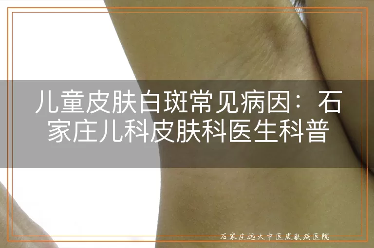 儿童皮肤白斑常见病因：石家庄儿科皮肤科医生科普