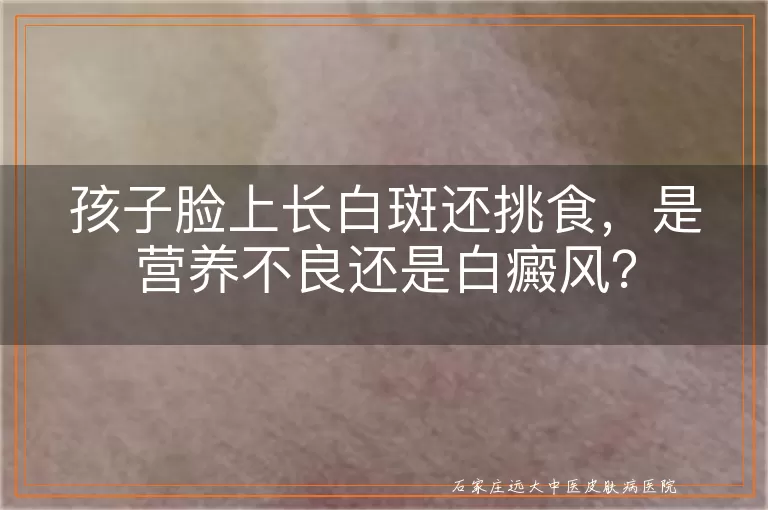 孩子脸上长白斑还挑食，是营养不良还是白癜风？
