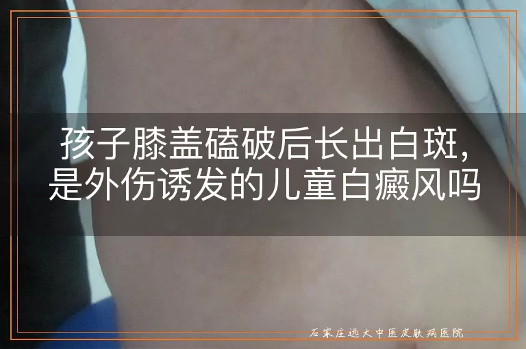 孩子膝盖磕破后长出白斑，是外伤诱发的儿童白癜风吗