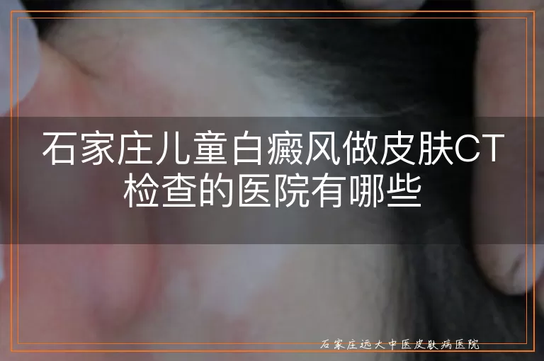 石家庄儿童白癜风做皮肤CT检查的医院有哪些