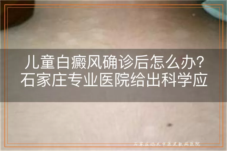 儿童白癜风确诊后怎么办？石家庄专业医院给出科学应对方案