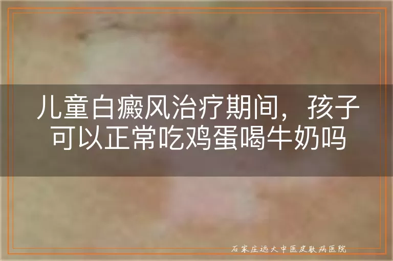 儿童白癜风治疗期间，孩子可以正常吃鸡蛋喝牛奶吗
