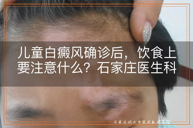 儿童白癜风确诊后，饮食上要注意什么？石家庄医生科普