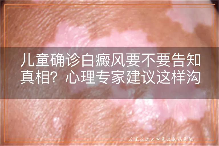 儿童确诊白癜风要不要告知真相?心理专家建议这样沟通更妥当