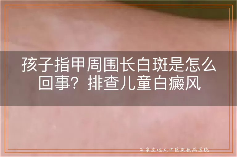 孩子指甲周围长白斑是怎么回事？排查儿童白癜风