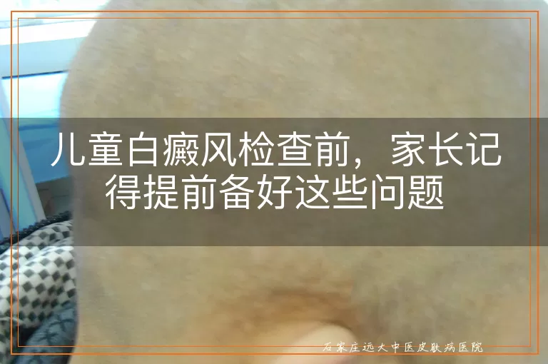 儿童白癜风检查前，家长记得提前备好这些问题