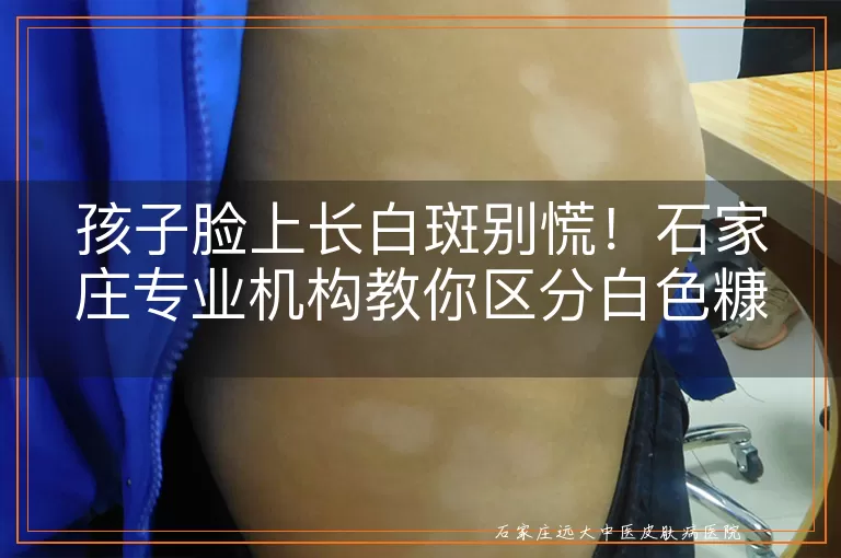 孩子脸上长白斑别慌!石家庄专业机构教你区分白色糠疹和白癜风