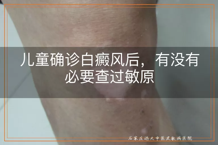 儿童确诊白癜风后,有没有必要查过敏原