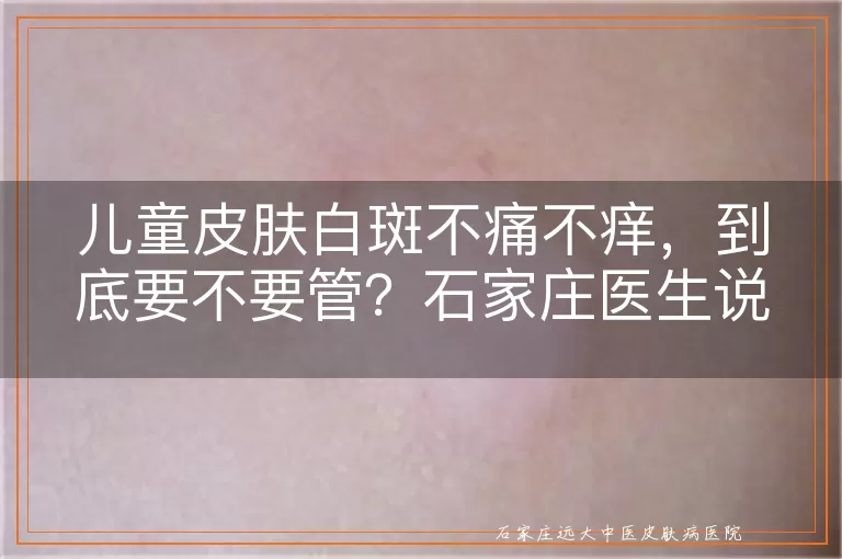 儿童皮肤白斑不痛不痒,到底要不要管?石家庄医生说出实情