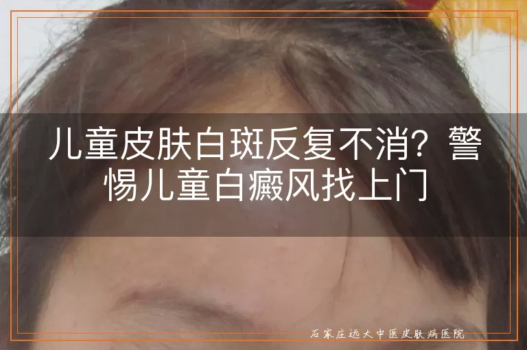 儿童皮肤白斑反复不消？警惕儿童白癜风找上门