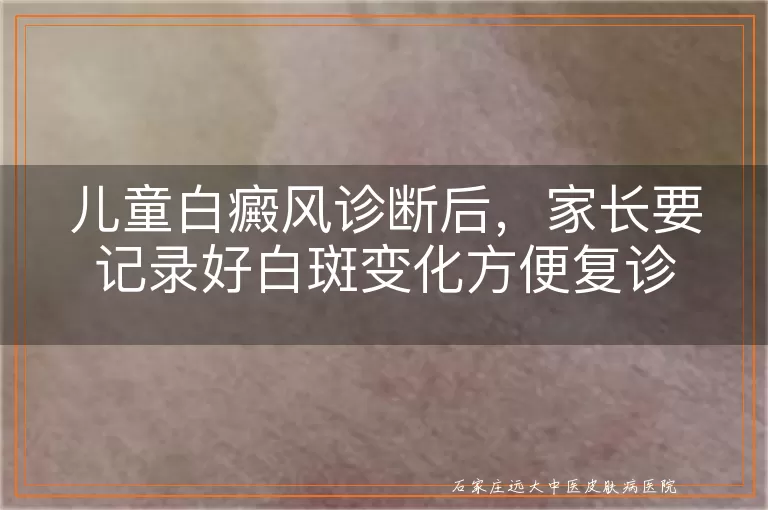 儿童白癜风诊断后，家长要记录好白斑变化方便复诊