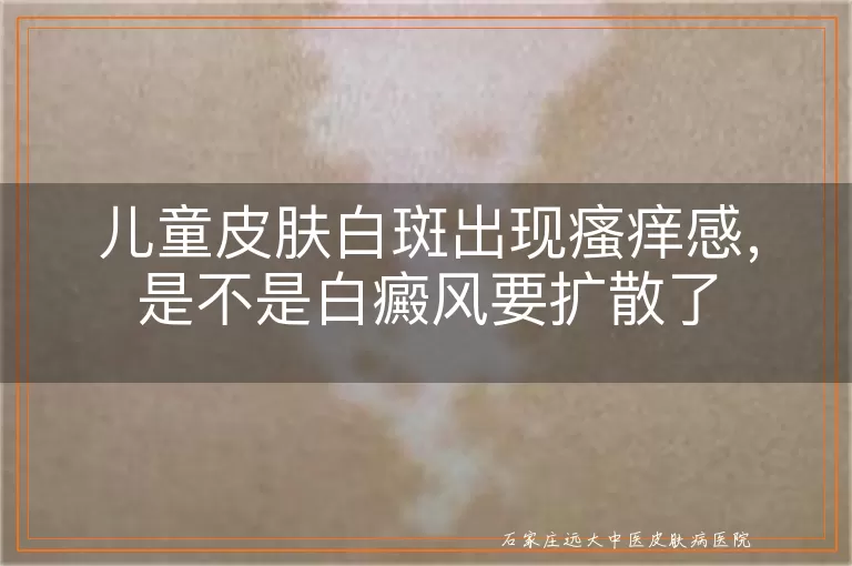 儿童皮肤白斑出现瘙痒感，是不是白癜风要扩散了