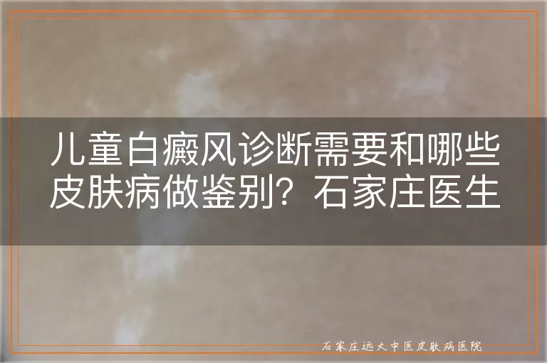 儿童白癜风诊断需要和哪些皮肤病做鉴别?石家庄医生详解
