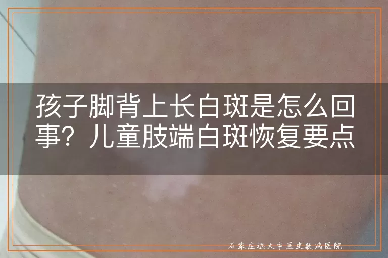 孩子脚背上长白斑是怎么回事？儿童肢端白斑恢复要点
