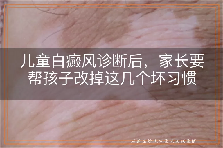 儿童白癜风诊断后，家长要帮孩子改掉这几个坏习惯