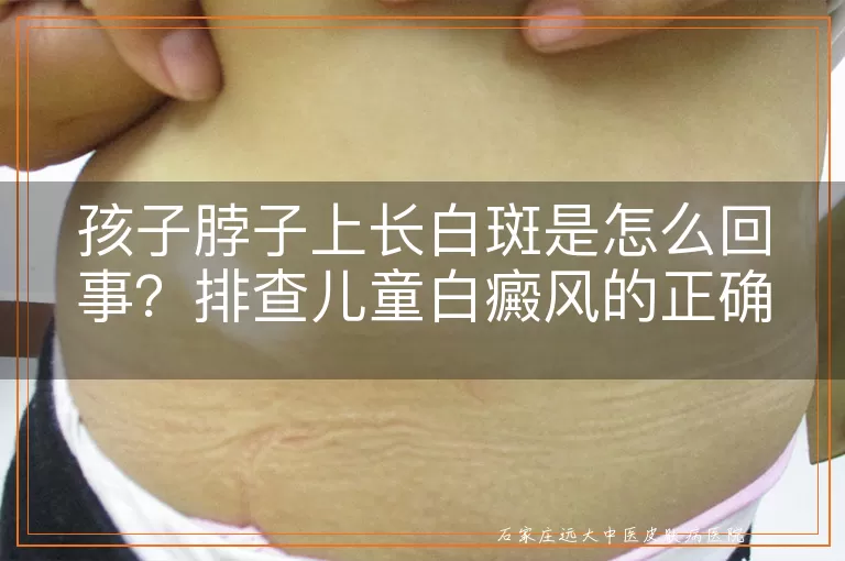 孩子脖子上长白斑是怎么回事？排查儿童白癜风的正确步骤